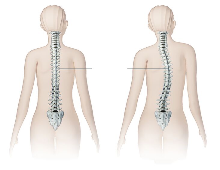 healthy and sore spine