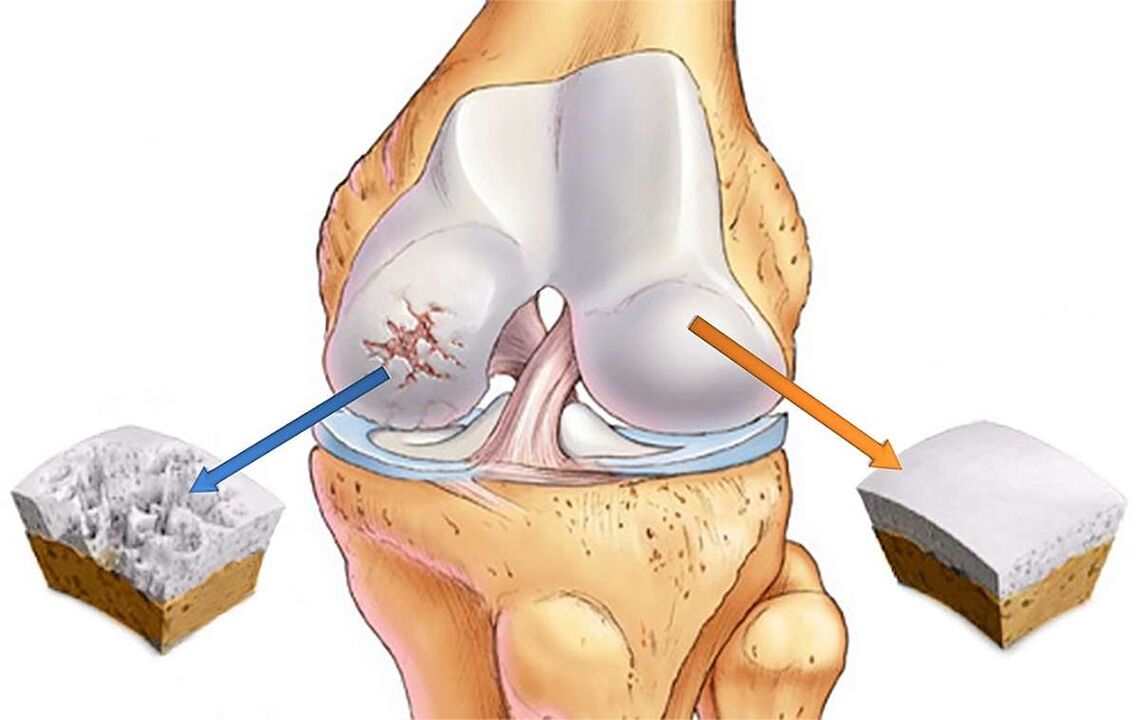 Cartilage destruction of the knee joint with gonarthrosis