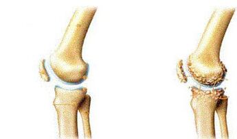 Symptoms of knee -based atrosis