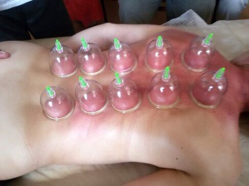 Vacuum cupping is the best way to treat lower back pain at home
