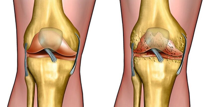 healthy joints and arthrosis of the knee joint